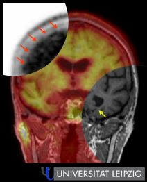 Hybrid-Amyloid-PET-MRT