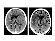 CT-Bild Gehirn
